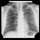 Lymphocytic interstitial pneumonia, cystic lung disease: X-ray - Plain radiograph